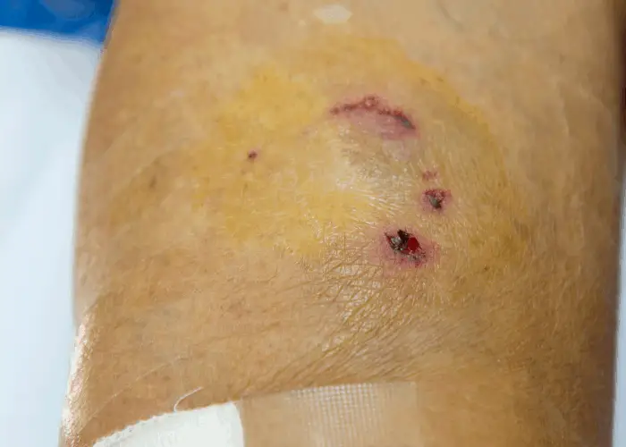 What is the Bite Force of a Chihuahua? 9 dog bite wound